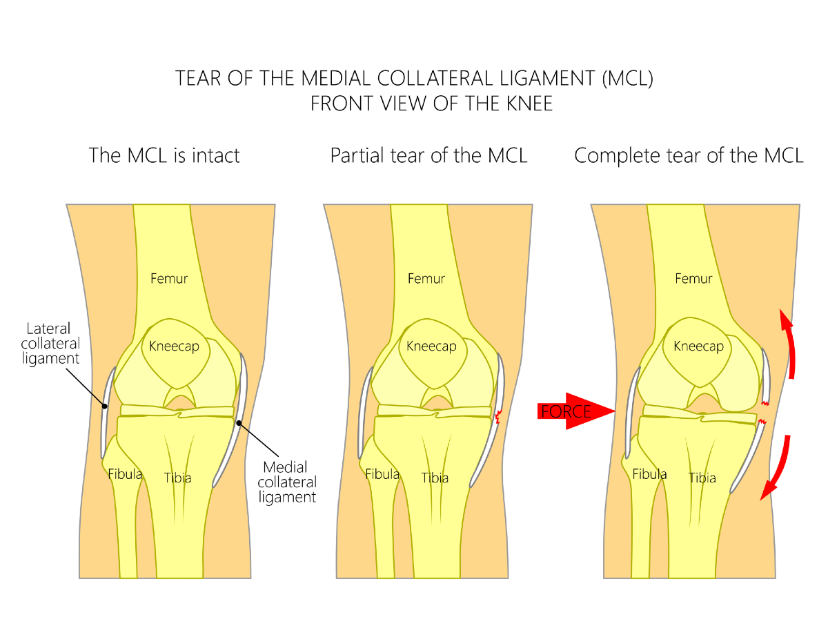 Medial Collateral Ligament (MCL) Tear Midtown East NY : Comprehensive PT  Associates